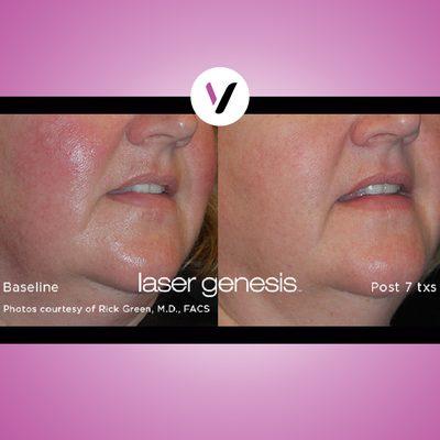 Laser Genesis is a noninvasive laser treatment  targeting fine lines, acne scars, large pores, and uneven skin tone.