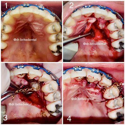 "Surgical canine guidance" with braces to restore impacted tooth