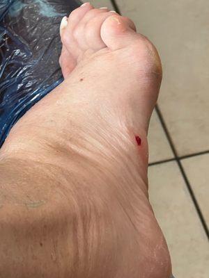 My bloody foot from a botched pedicure.