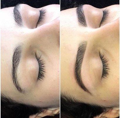 Micropigmentation can add fullness in the eyebrow. After one session