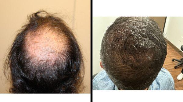 31 year old male with 2,083 grafts placed into the crown. Note the re-creation of the patients natural swirl pattern