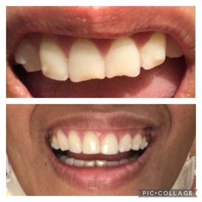 Photo of before and after dental work today.