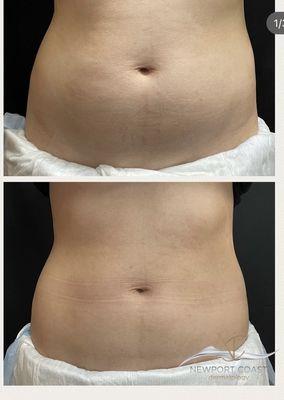 Coolsculpting ABD