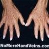 hand veins after treatment