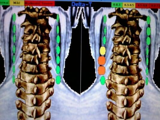 I use thermography pre and post upper cervical adjustments.