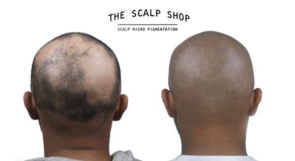 Scalp Micro Pigmentation results  at The Scalp Shop for Alopecia hair loss NYC