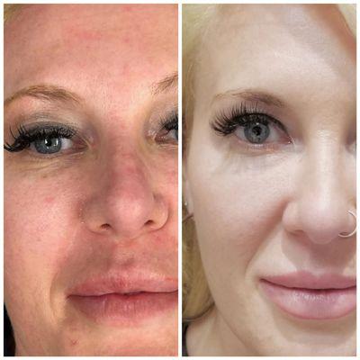 Co2 laser facial resurfacing plus lip fillers