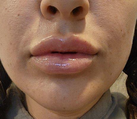 1 day healed - 1 syringe Juvederm Ultra