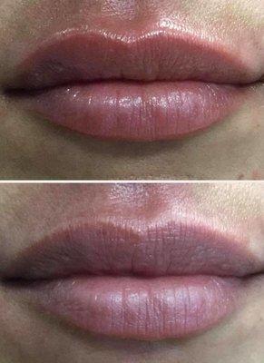 Beautiful, subtle lip filler touch up.