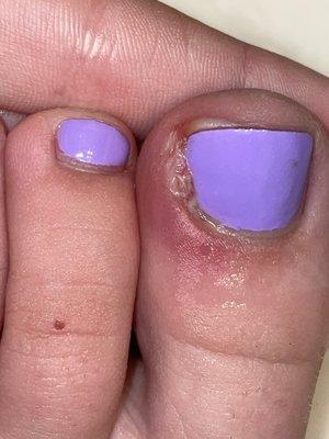 Infected toenail.