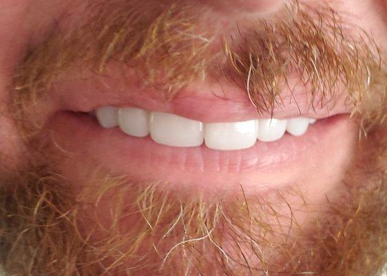 Time to trim that hair. But look at those great veneers.  I bet you think those are real teeth.