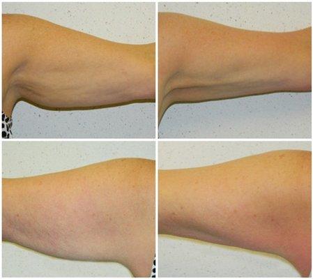 45-54 year old woman treated with Arm lift