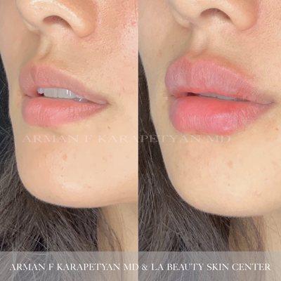 Non-surgical lip augmentation by Arman F Karapetyan, MD. Gorgeous transformation!