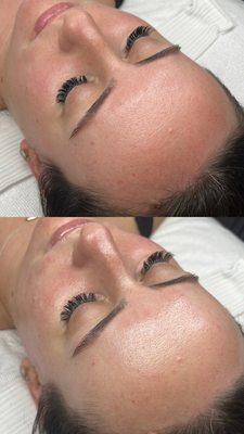 before + after Hydrafacial