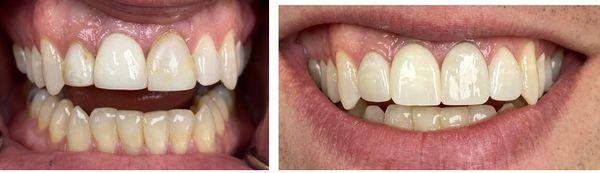 Old implant crown and stained composite bonding replaced with a new implant crown and veneers. A more symmetrical smile was achieved.