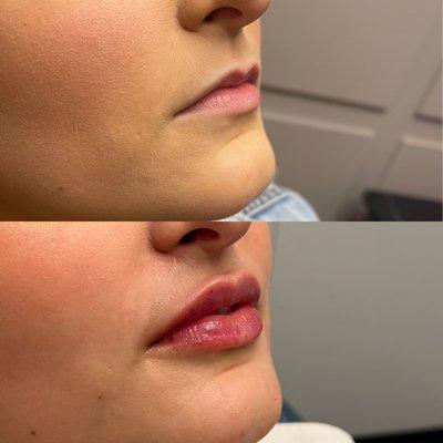 Lip Filler