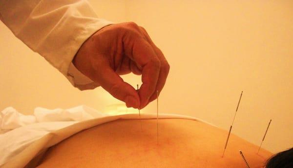 Dr. Shi performing acupuncture