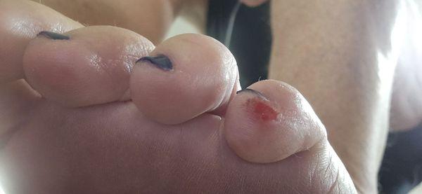 Here's the bloody tip of my sanded toe