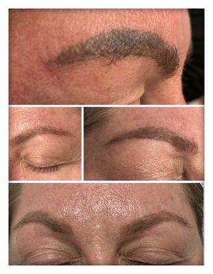 Laser tattoo removal of brows