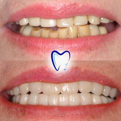 Full smile makeovers are available with us - we offer dental crowns, bridges, implants, dentures, whitening, veneers, Invisalign and more!