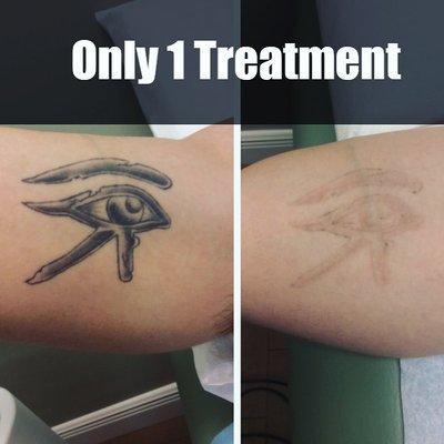 Our advanced Enlighten laser technology has amazing results for our patients!