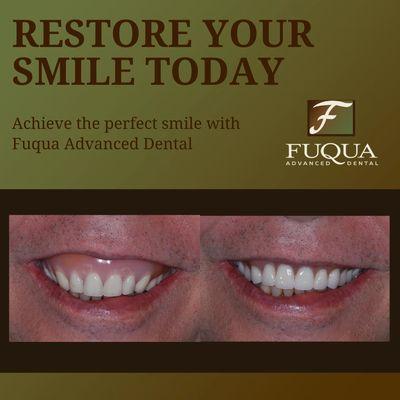 Before & After Results at Fuqua Advanced Dental | Southlake, TX