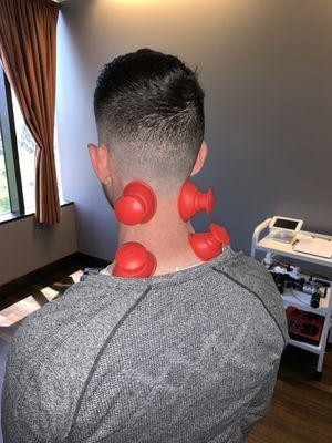 Using silicone cups make it easier to do some active cupping techniques. Myofascial techniques also help adjustments hold longer