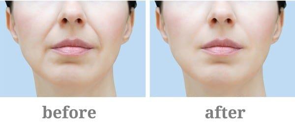 Restylane provides a long lasting and natural looking result.