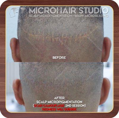 Microhair Studio: Scalp Micropigmentation, (FUT) SCAR CAMOUFLAGE.