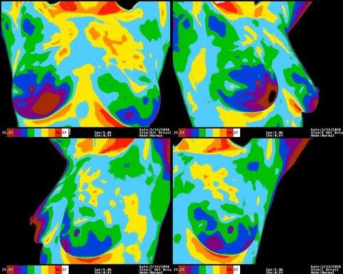 Breast Thermography at Pacific Naturopathic