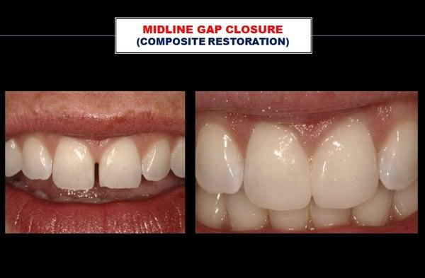 CASE 52: Composite filling