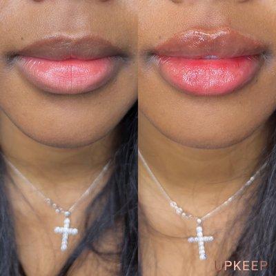 LIP FILLER