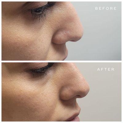 Before and after nose lift