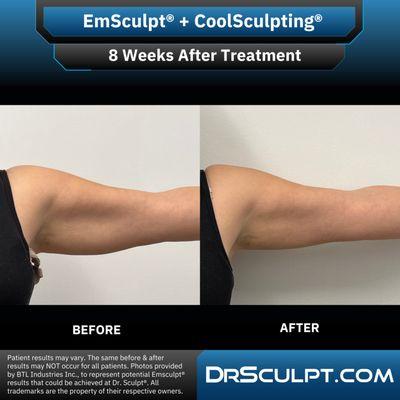 8 weeks after EmSculpt + CoolSculpting treatments on arms