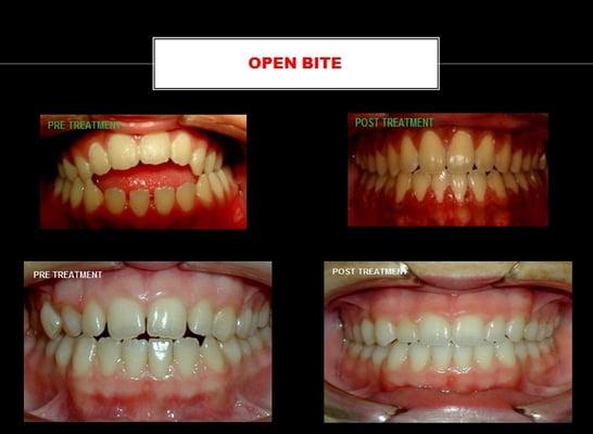 CASE 115 & 201: Open bite