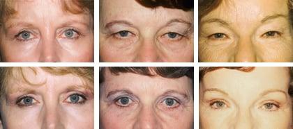 Eyelid Surgery/Blepharoplasty removes puffiness and bags under the eyes that make you look worn and tired.