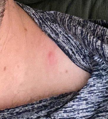 Bug bite on shoulder from laying on the bed.