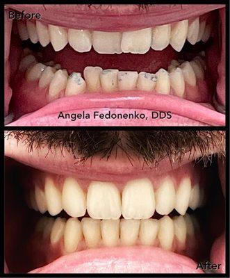 Fantastic transformation with 7 months of Invisalign