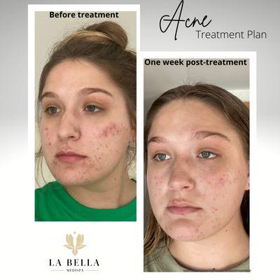 Acne before and after hydrafacials, chemical peels, and medical grade skincare