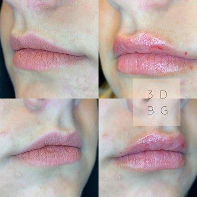 Haya Lip Enhancement done by infusing hylauronic acid (already exists in our body) into the lips. Lasts 4-6 months. Safe and non-invasive