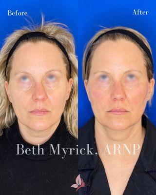 PRF under eye injections