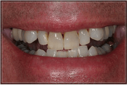 Few porcelain veneers corrects his uneven teeth.