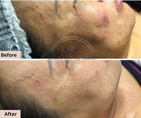 Acne and Acne scars treatmenets.