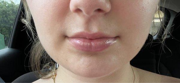 My lips before. I wanted my top lip to appear fuller and to not thin out when I smile and talk.