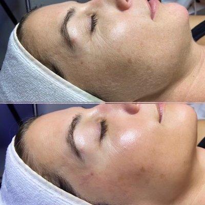 Dermaplane with HydraFacial by Emily!