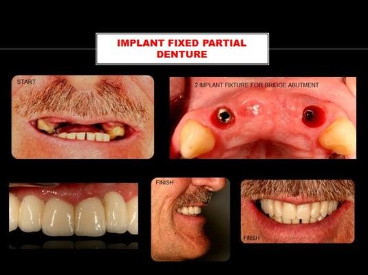 CASE 457: Implant bridge