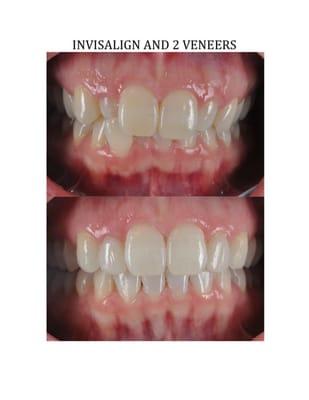 Smile lift by Dr. Tracey Nguyen- Invisalign and 2 No prep Veneers