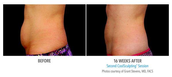 Check out these amazing Coolsculpting results!