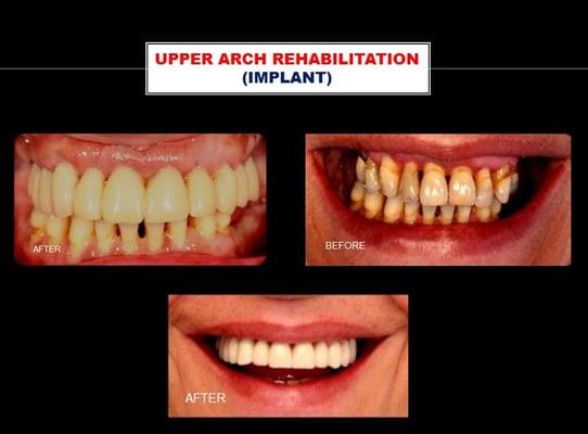 CASE 16: Full upper arch implant