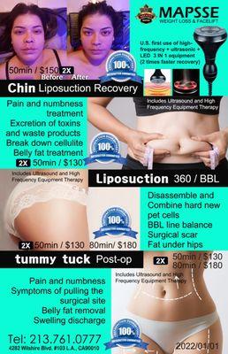 Liposuction Post-op lymphatic drainage massage